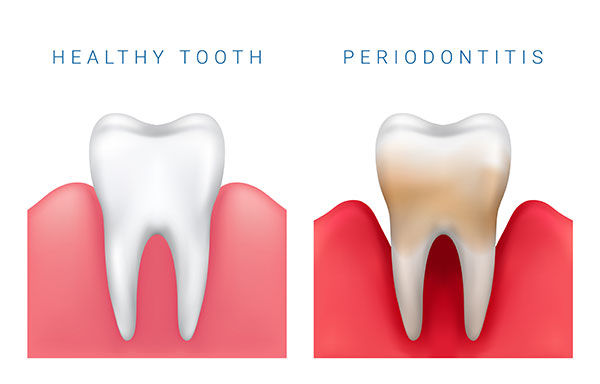 Periodontal service imagery from Vancouver Island Dental Specialists
